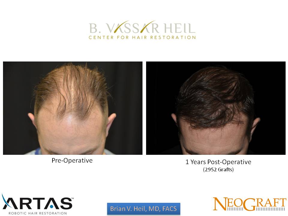 Hair Restoration Before and After | Premier Plastic Surgery