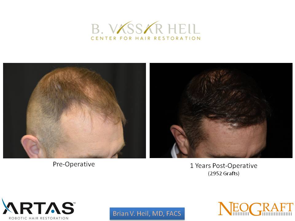 Hair Restoration Before and After | Premier Plastic Surgery