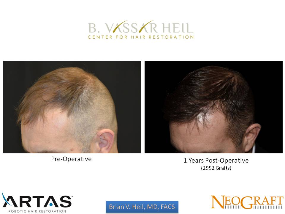 Hair Restoration Before and After | Premier Plastic Surgery