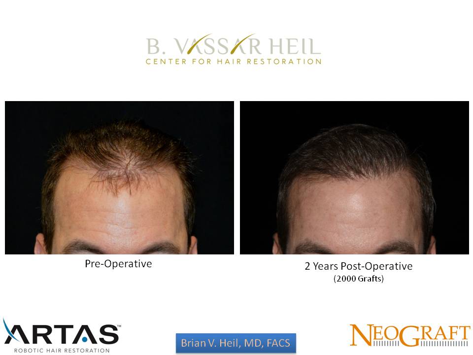 Hair Restoration Before and After | Premier Plastic Surgery