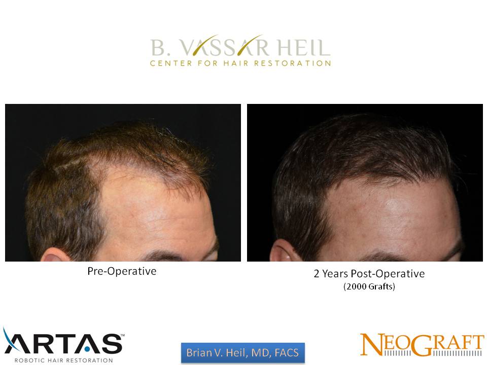 Hair Restoration Before and After | Premier Plastic Surgery