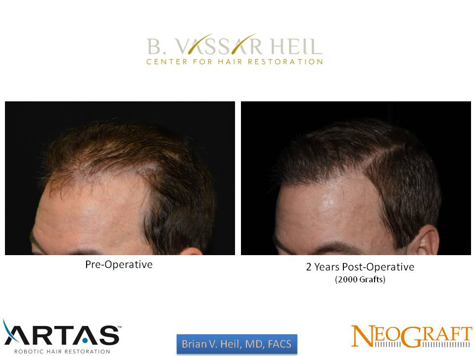 Hair Restoration Before and After | Premier Plastic Surgery