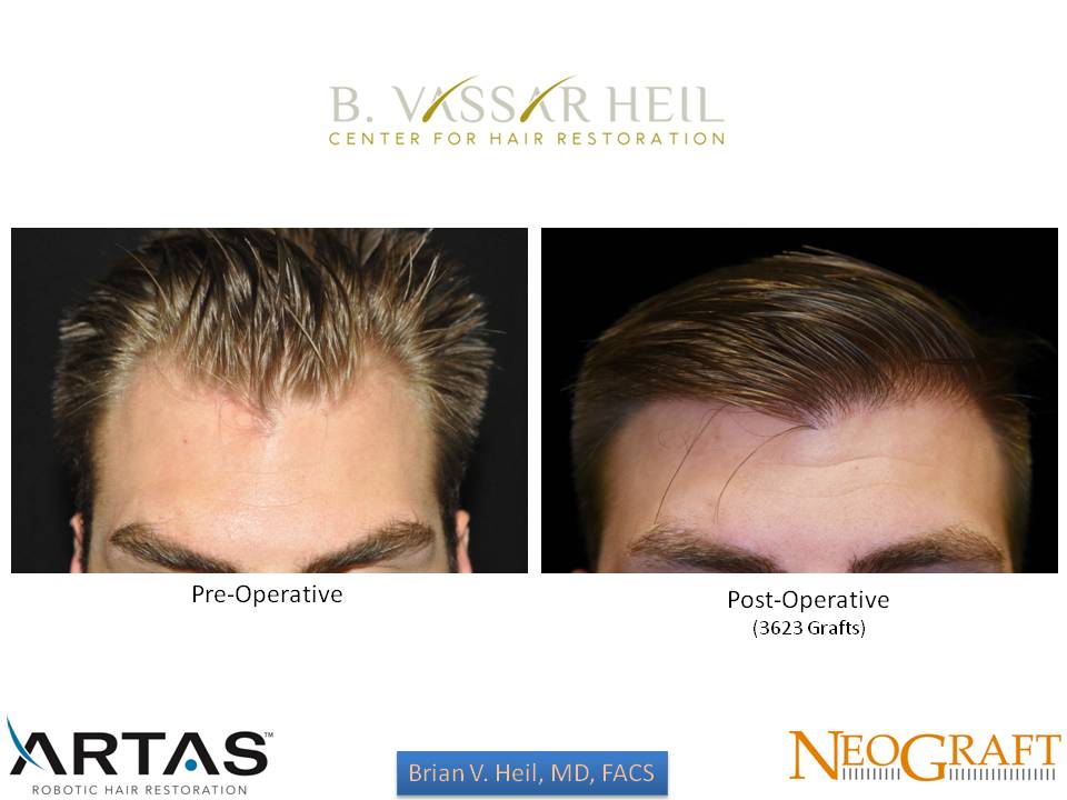 Hair Restoration Before and After | Premier Plastic Surgery