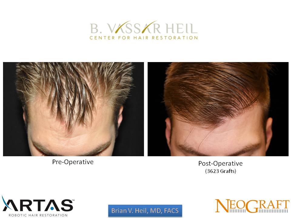 Hair Restoration Before and After | Premier Plastic Surgery