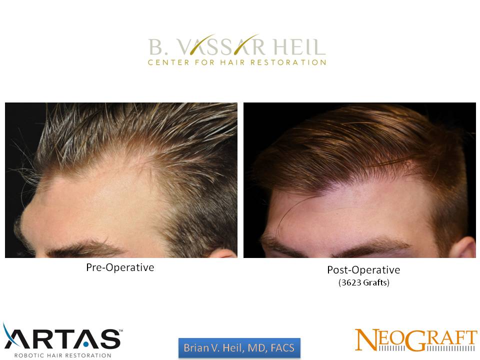 Hair Restoration Before and After | Premier Plastic Surgery