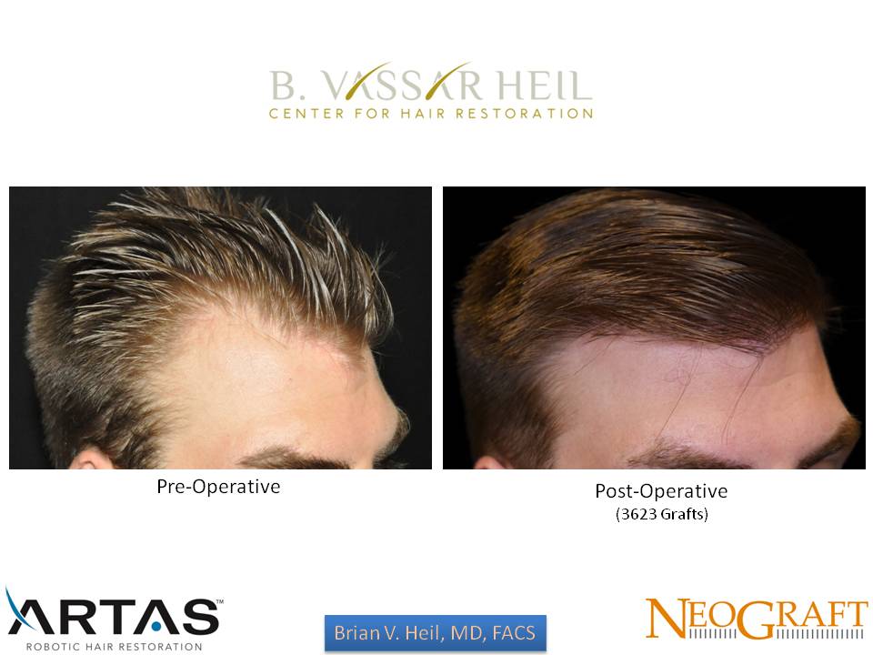 Hair Restoration Before and After | Premier Plastic Surgery