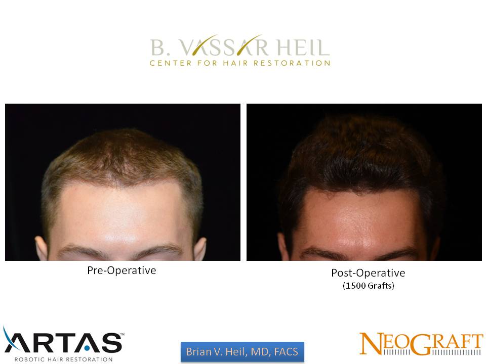 Hair Restoration Before and After | Premier Plastic Surgery