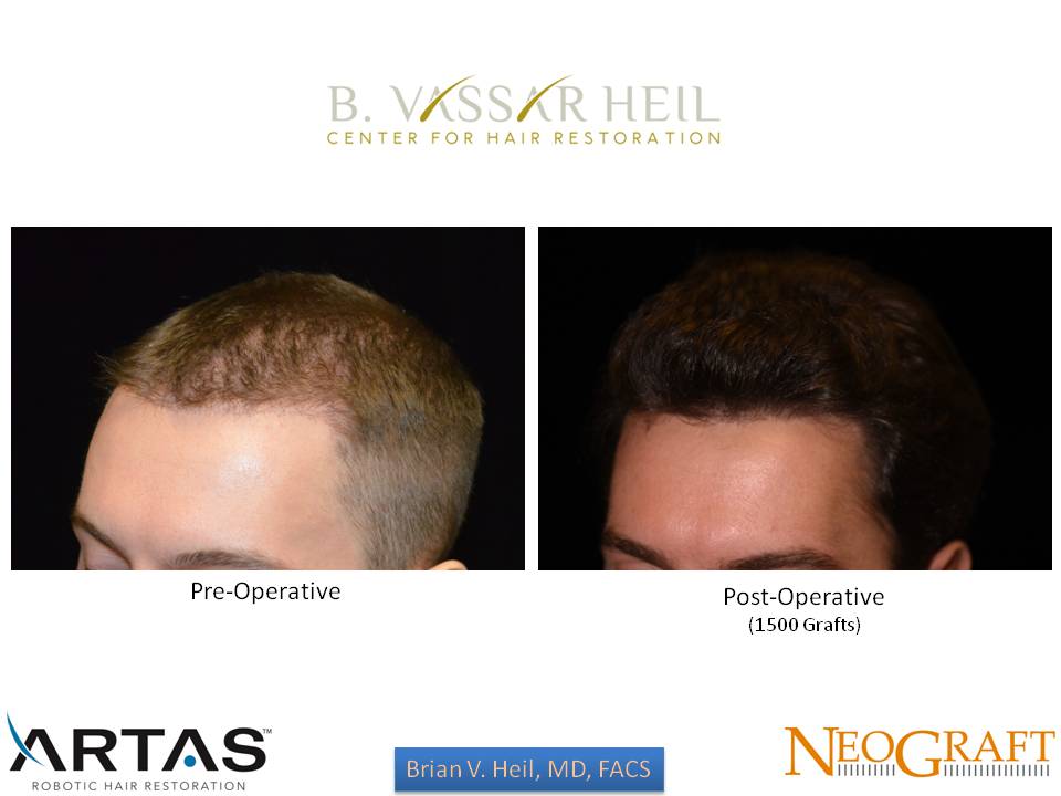 Hair Restoration Before and After | Premier Plastic Surgery