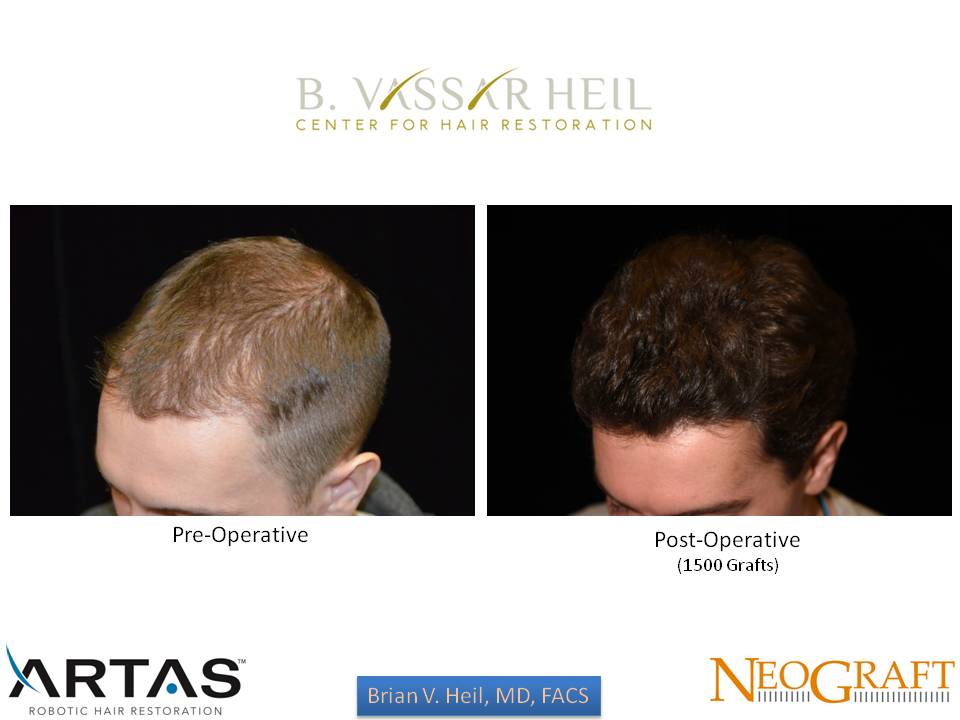 Hair Restoration Before and After | Premier Plastic Surgery