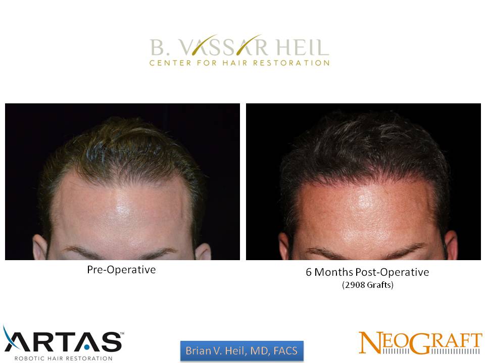 Hair Restoration Before and After | Premier Plastic Surgery