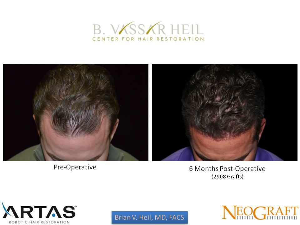 Hair Restoration Before and After | Premier Plastic Surgery