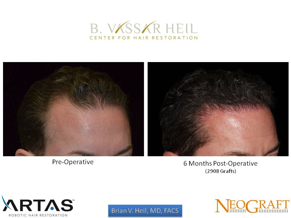 Hair Restoration Before and After | Premier Plastic Surgery