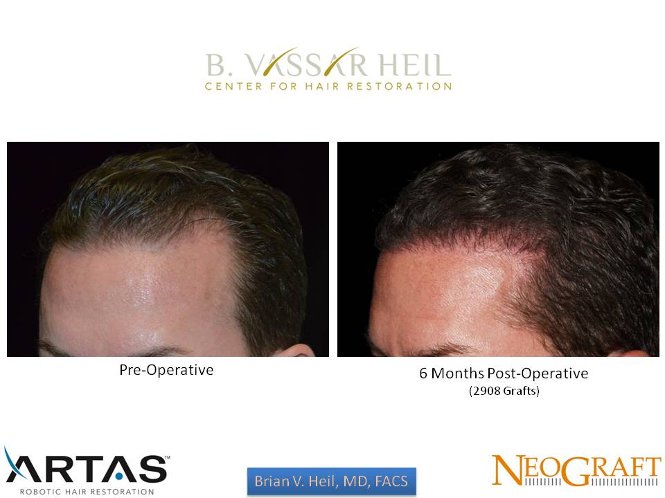 Hair Restoration Before and After | Premier Plastic Surgery