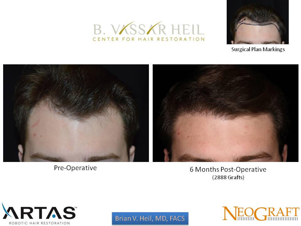 Hair Restoration Before and After | Premier Plastic Surgery