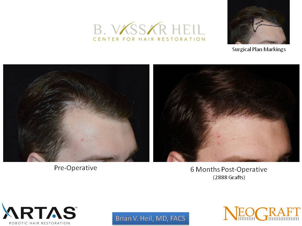 Hair Restoration Before and After | Premier Plastic Surgery