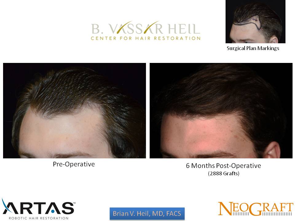 Hair Restoration Before and After | Premier Plastic Surgery