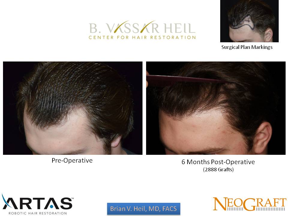 Hair Restoration Before and After | Premier Plastic Surgery