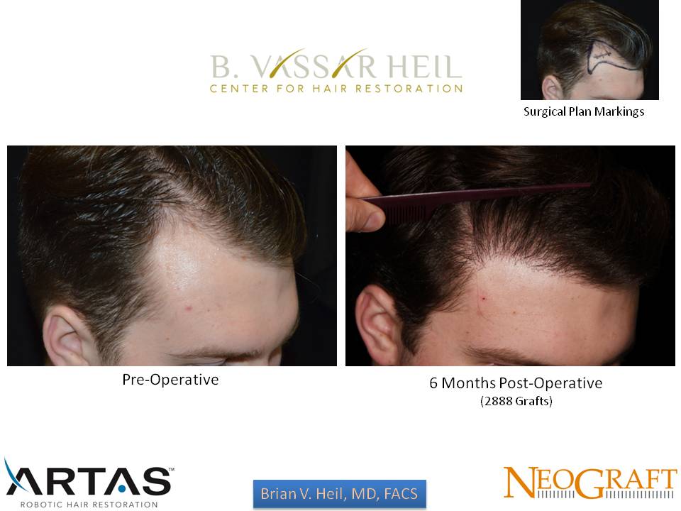 Hair Restoration Before and After | Premier Plastic Surgery