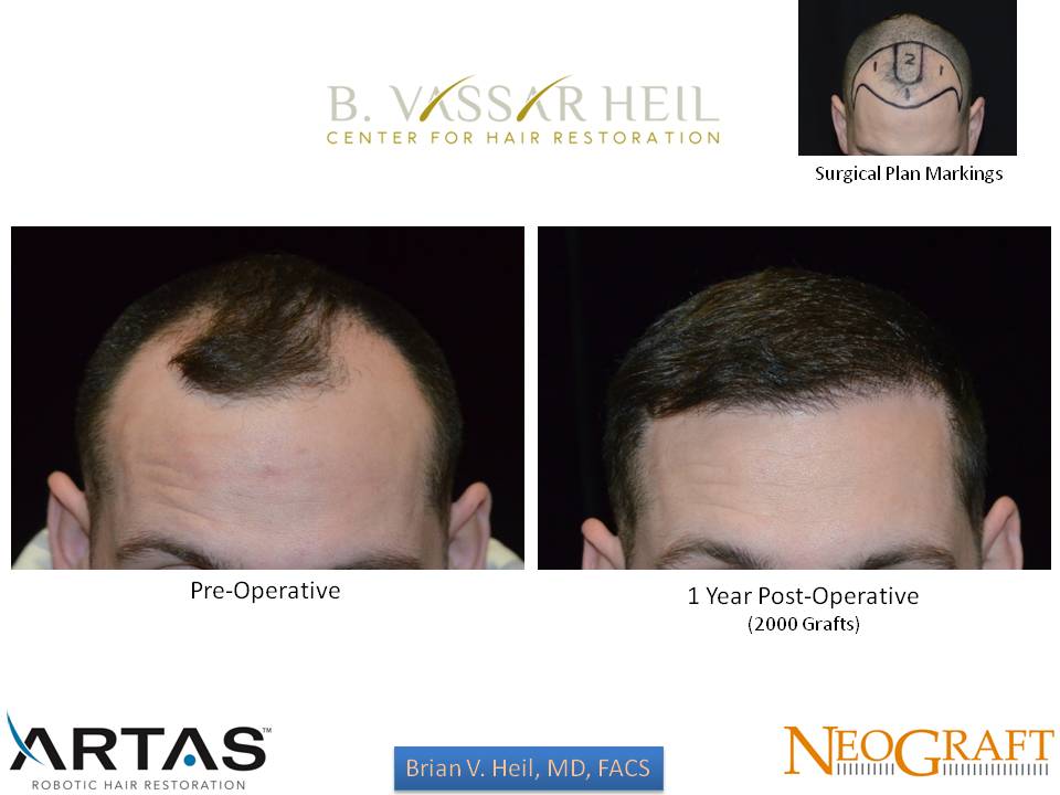 Hair Restoration Before and After | Premier Plastic Surgery