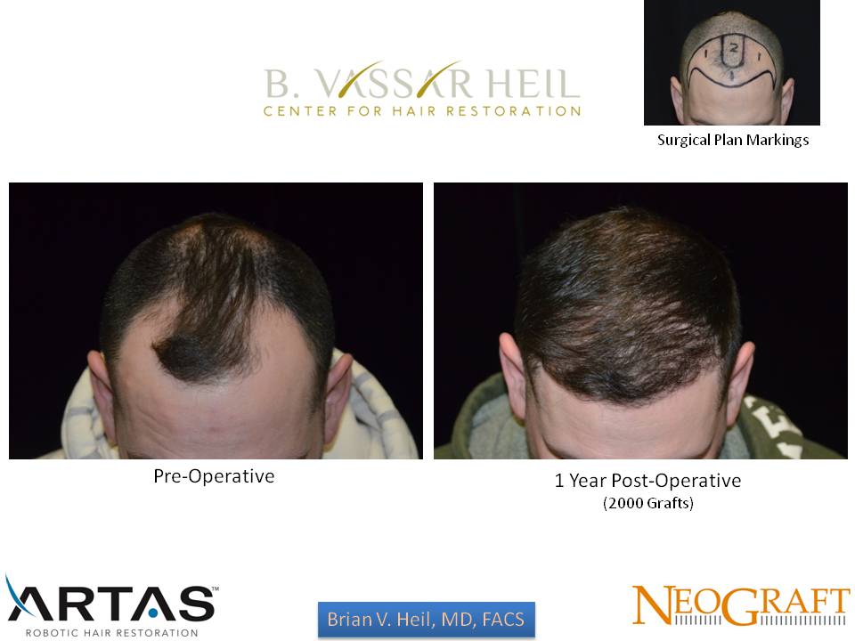 Hair Restoration Before and After | Premier Plastic Surgery