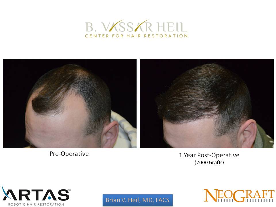 Hair Restoration Before and After | Premier Plastic Surgery