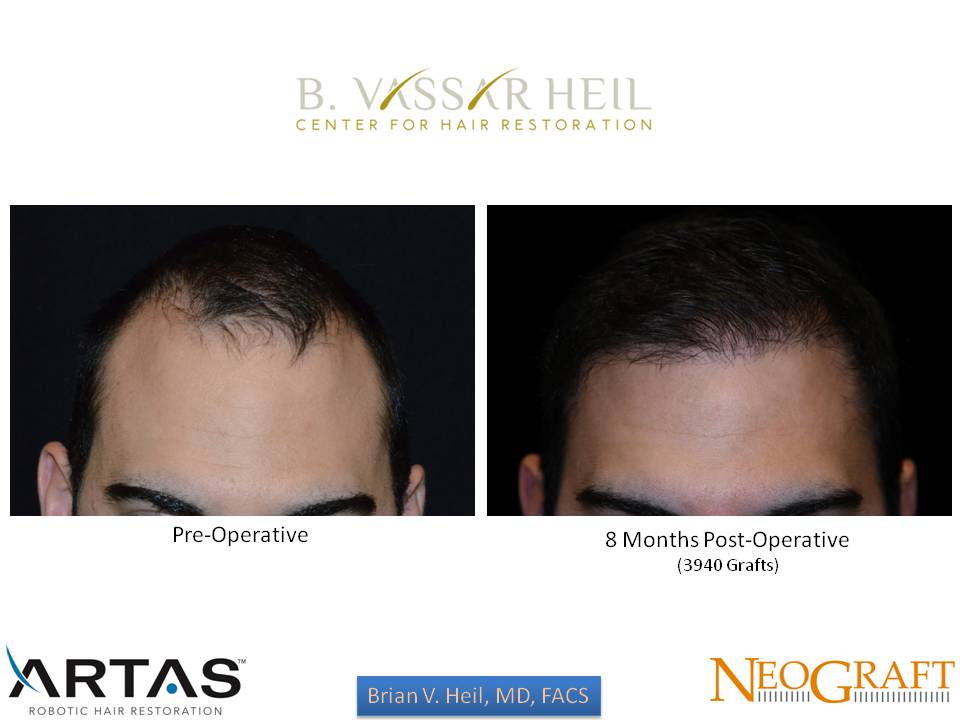 Hair Restoration Before and After | Premier Plastic Surgery