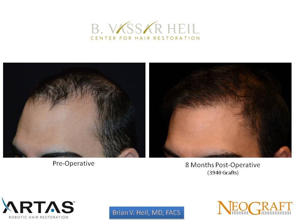 Hair Restoration Before and After | Premier Plastic Surgery