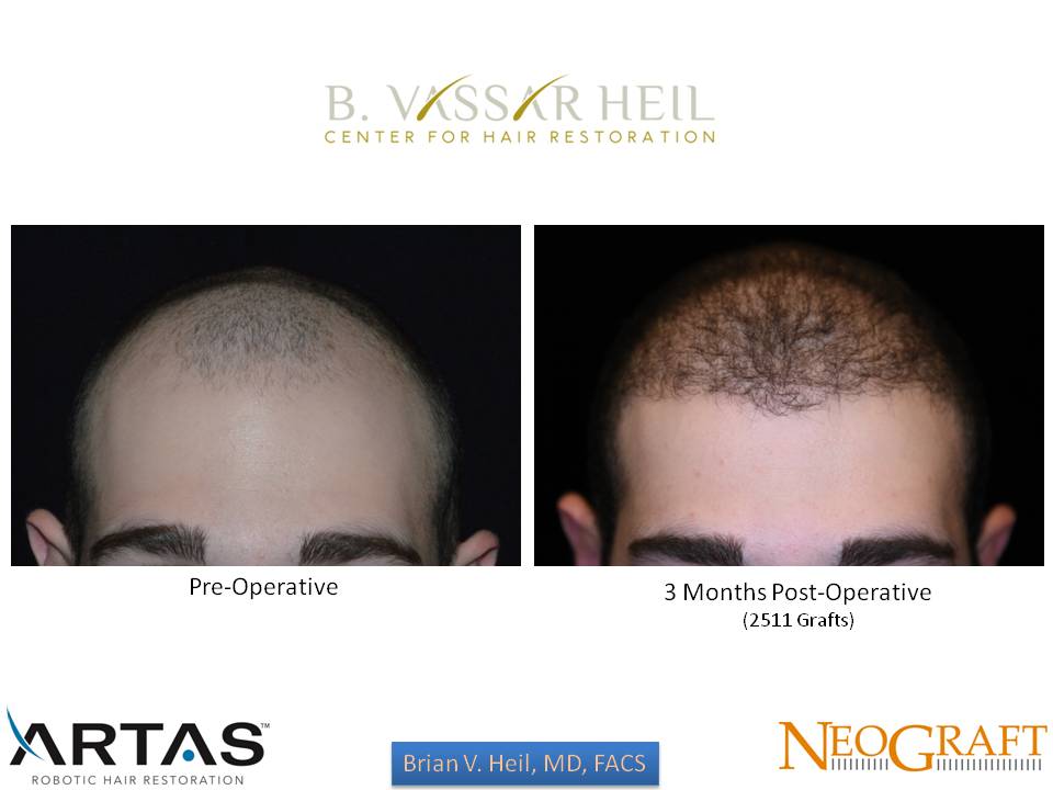 Hair Restoration Before and After | Premier Plastic Surgery