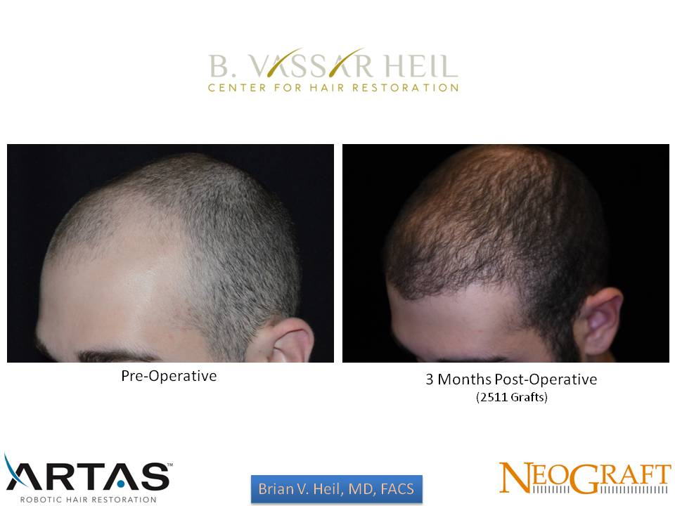 Hair Restoration Before and After | Premier Plastic Surgery