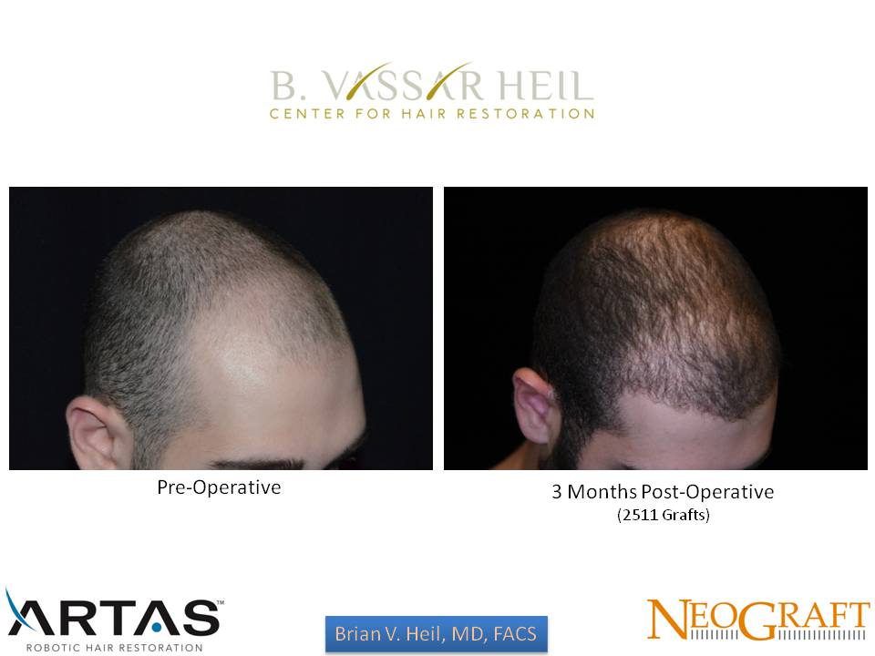 Hair Restoration Before and After | Premier Plastic Surgery