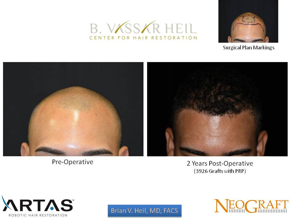 Hair Restoration Before and After | Premier Plastic Surgery