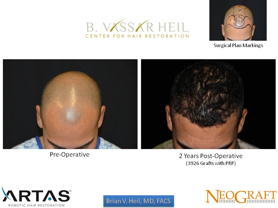 Hair Restoration Before and After | Premier Plastic Surgery