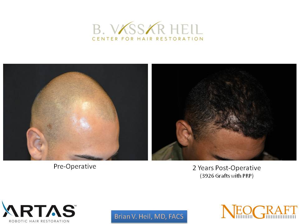 Hair Restoration Before and After | Premier Plastic Surgery