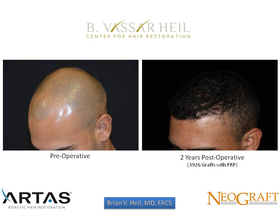 Hair Restoration Before and After | Premier Plastic Surgery