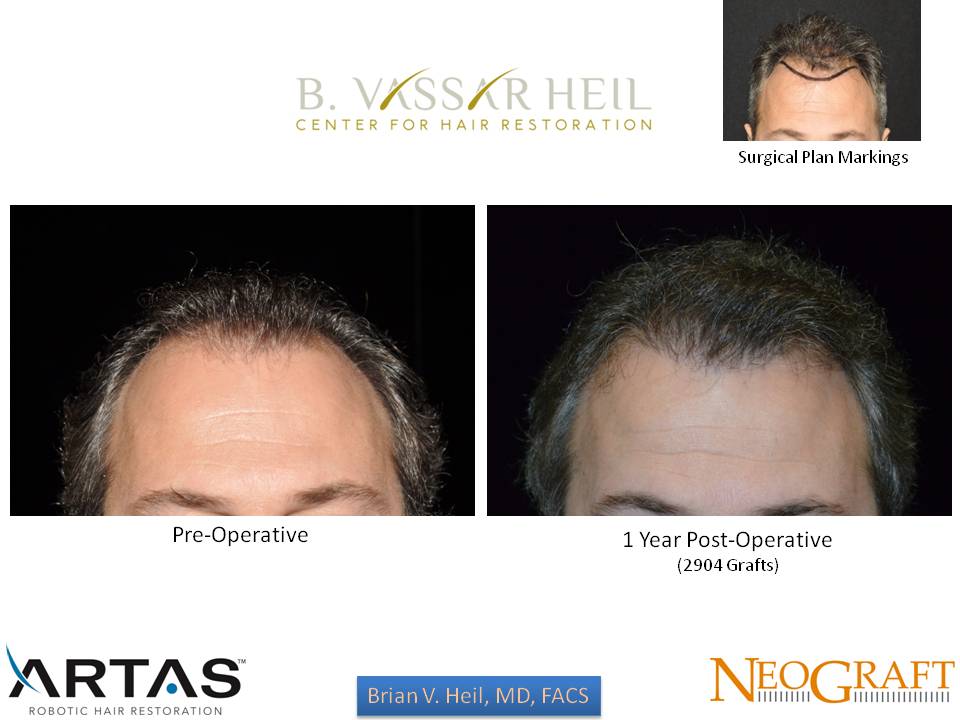 Hair Restoration Before and After | Premier Plastic Surgery