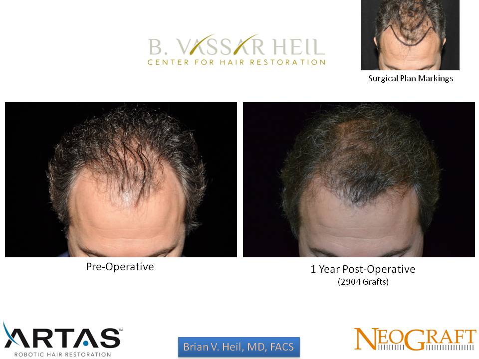 Hair Restoration Before and After | Premier Plastic Surgery