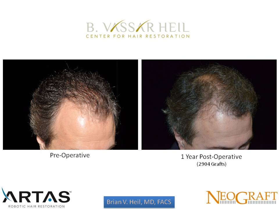 Hair Restoration Before and After | Premier Plastic Surgery