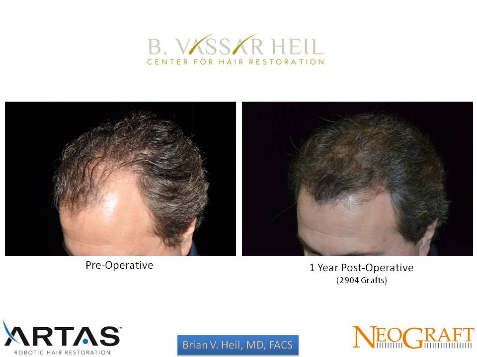 Hair Restoration Before and After | Premier Plastic Surgery