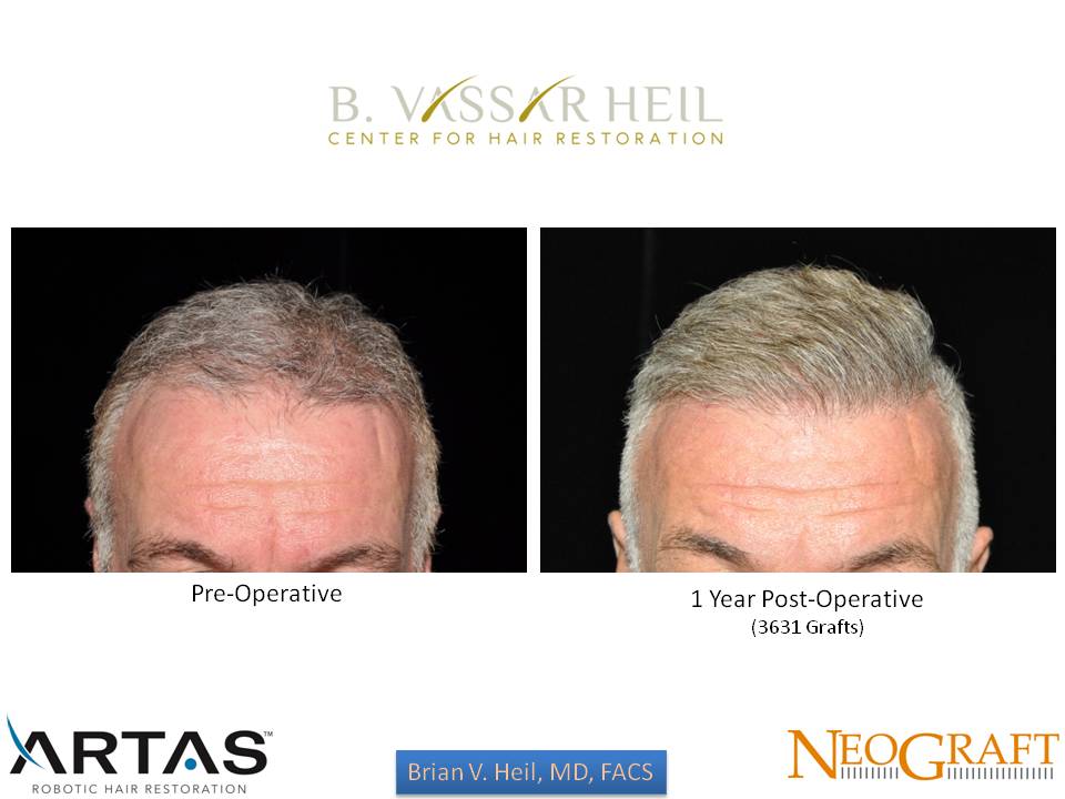 Hair Restoration Before and After | Premier Plastic Surgery