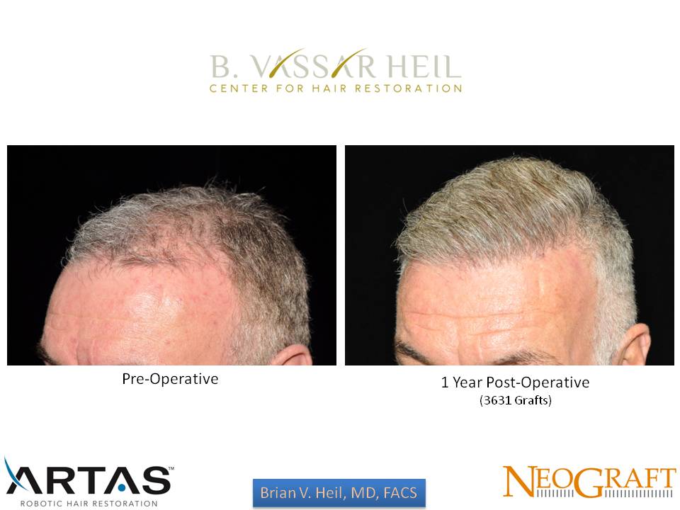 Hair Restoration Before and After | Premier Plastic Surgery