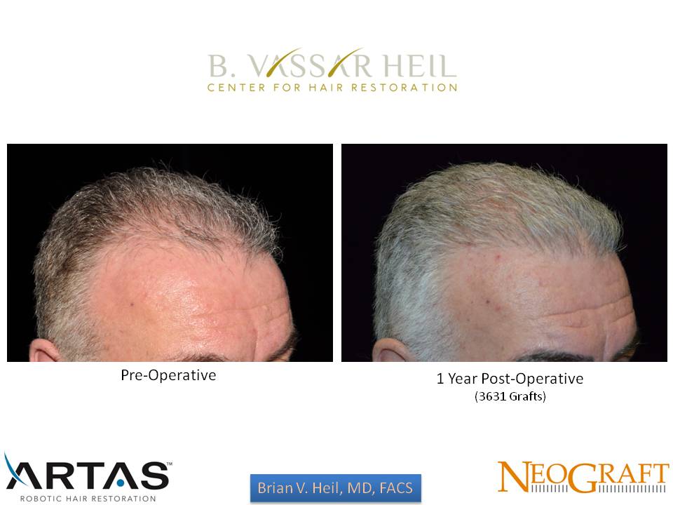 Hair Restoration Before and After | Premier Plastic Surgery