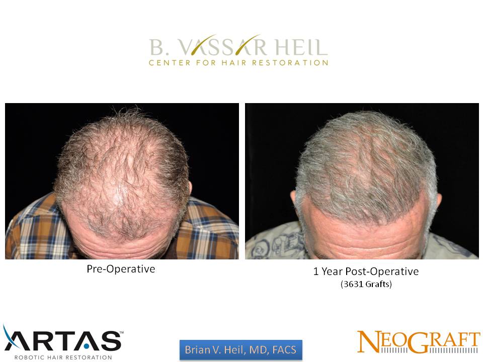 Hair Restoration Before and After | Premier Plastic Surgery