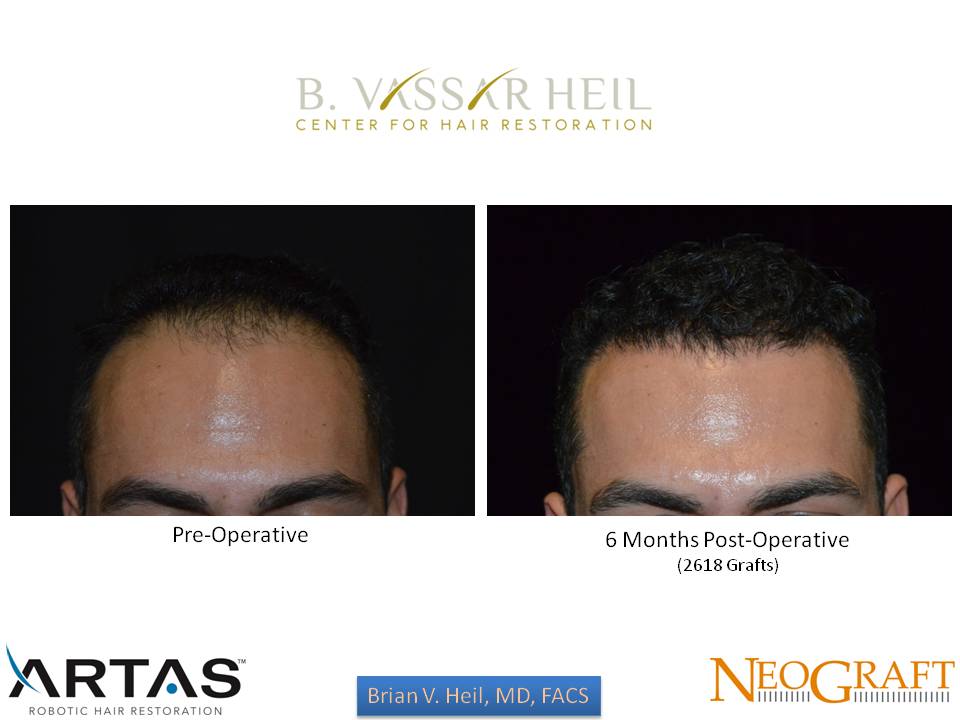 Hair Restoration Before and After | Premier Plastic Surgery