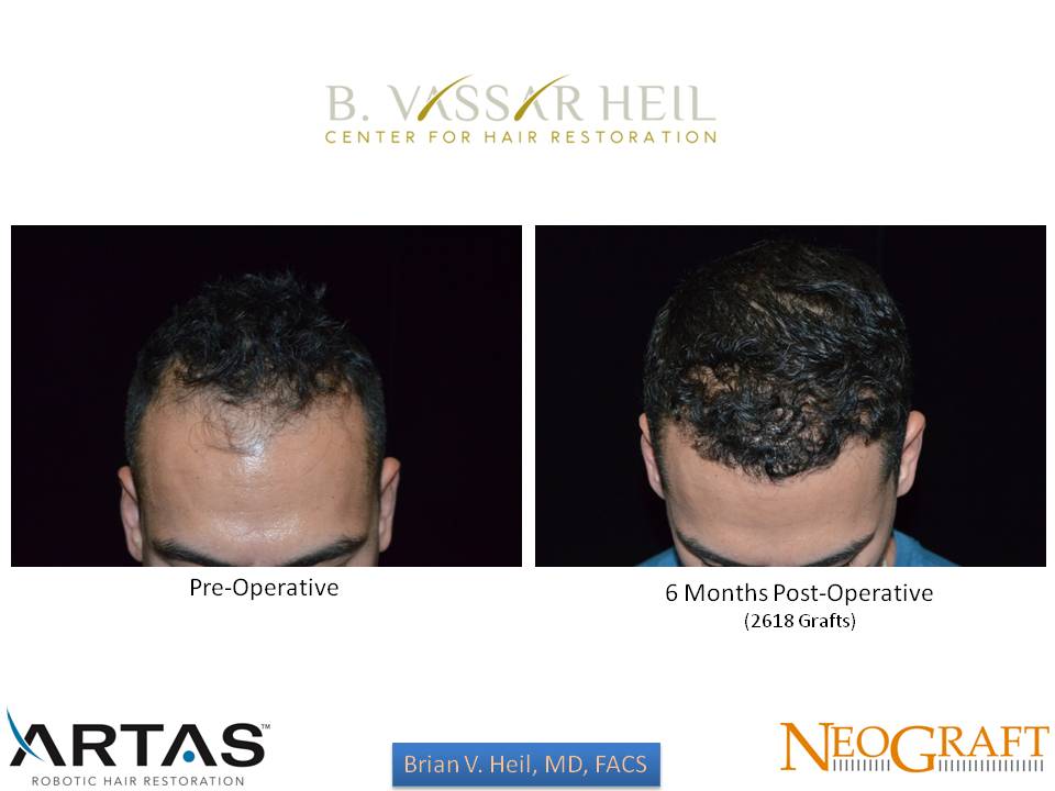 Hair Restoration Before and After | Premier Plastic Surgery