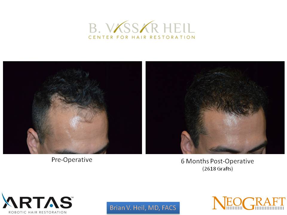 Hair Restoration Before and After | Premier Plastic Surgery