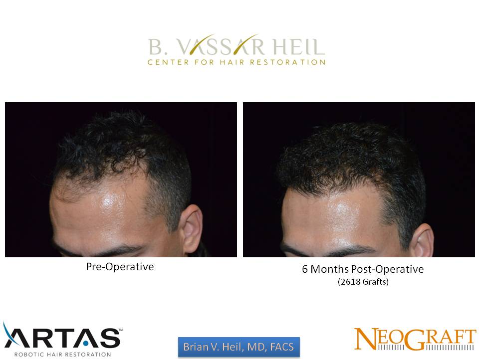 Hair Restoration Before and After | Premier Plastic Surgery