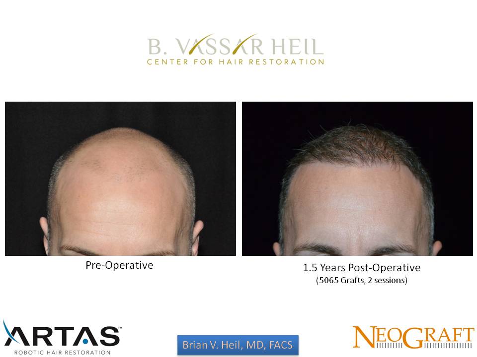 Hair Restoration Before and After | Premier Plastic Surgery