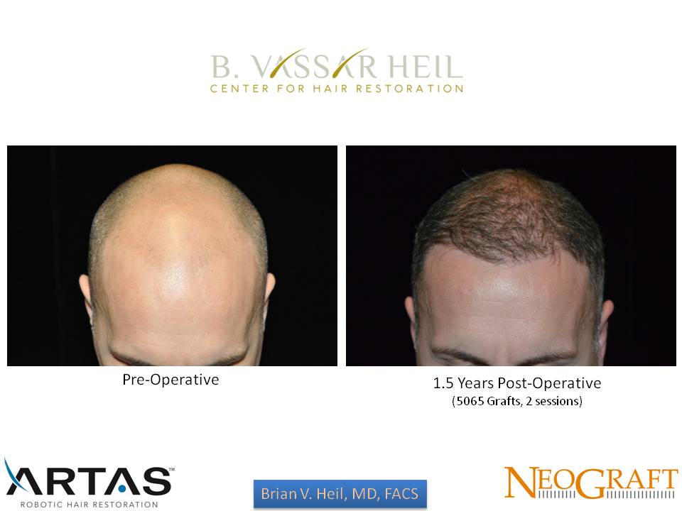 Hair Restoration Before and After | Premier Plastic Surgery