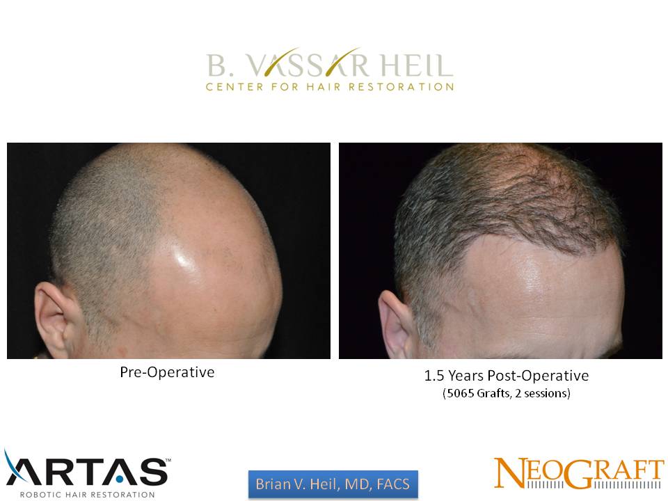 Hair Restoration Before and After | Premier Plastic Surgery