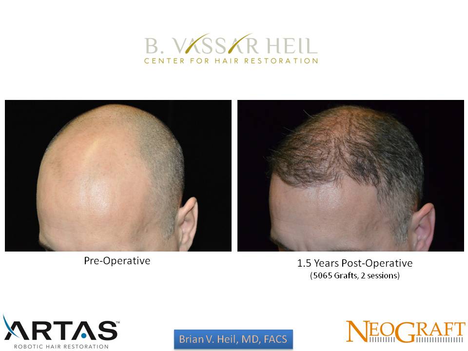 Hair Restoration Before and After | Premier Plastic Surgery